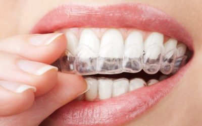 10 Common Tooth Whitening Mistakes