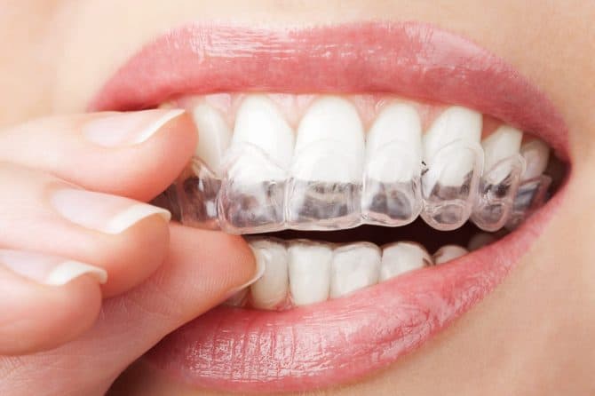 10 Common Tooth Whitening Mistakes