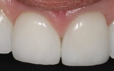 5 Things You Must Know About Veneers