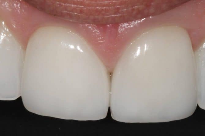 5 Things You Must Know About Veneers