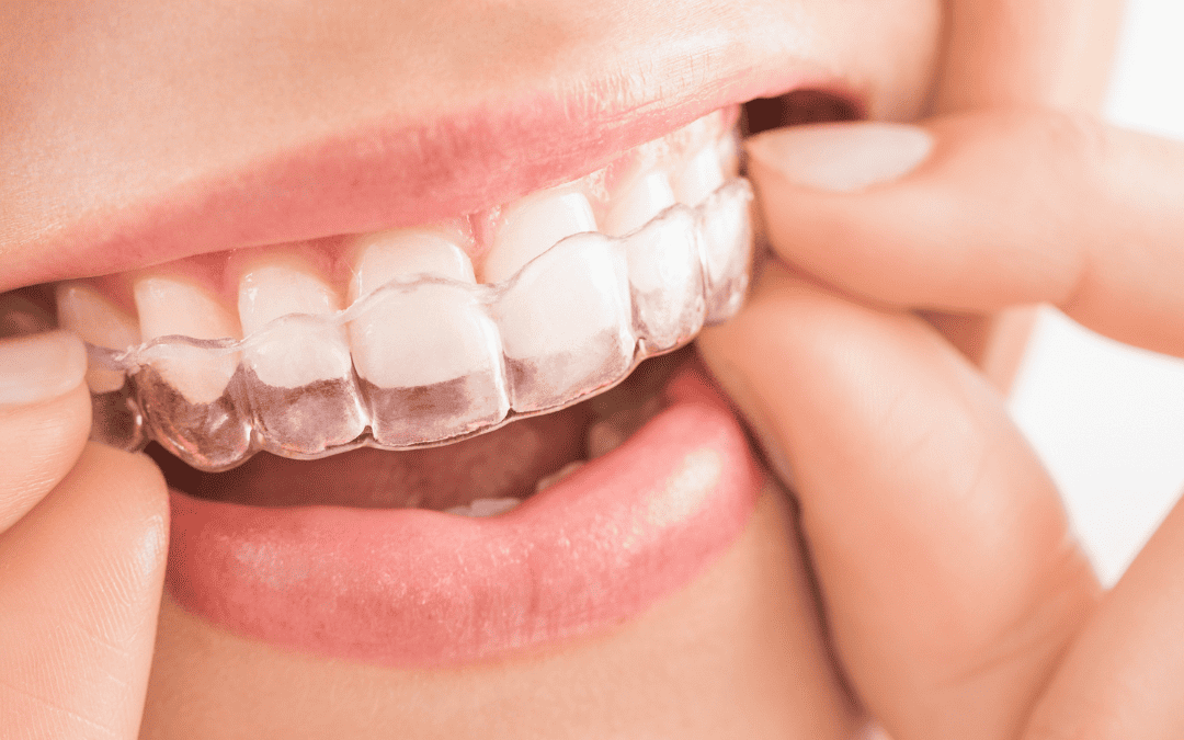 How To Get The Most From Your Tooth Whitening