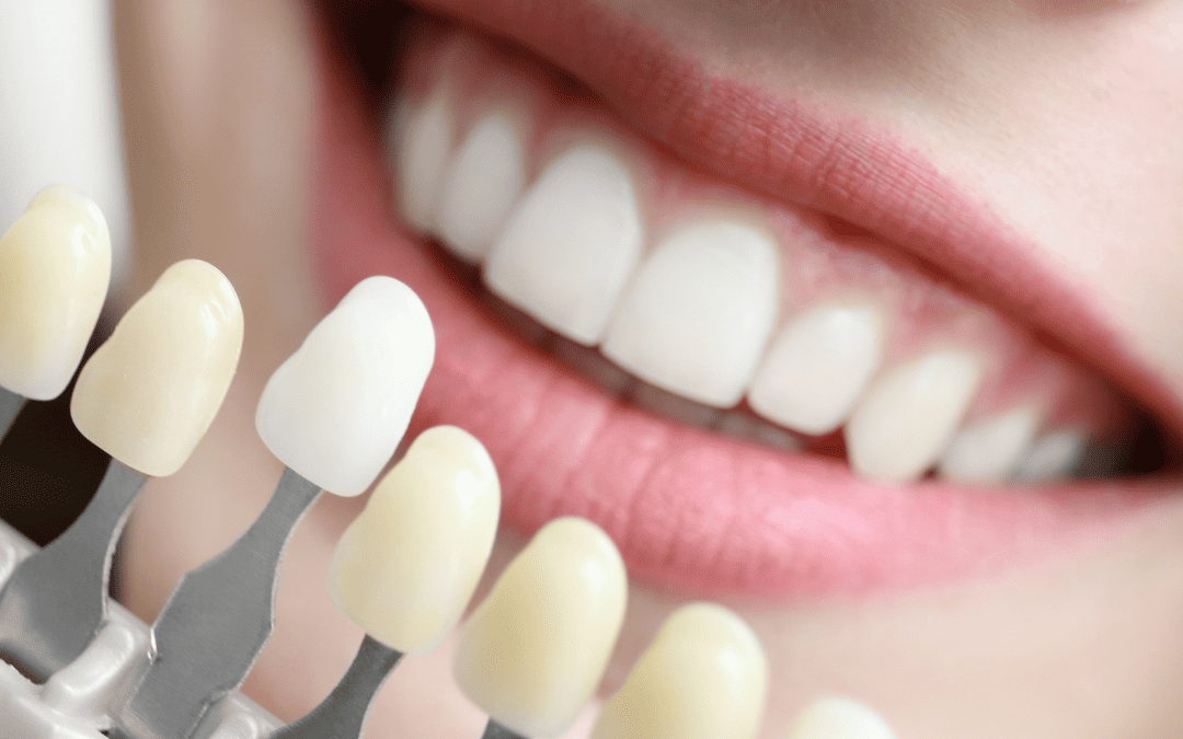 Achieve a Radiant Smile: Professional Tooth Whitening in Brisbane