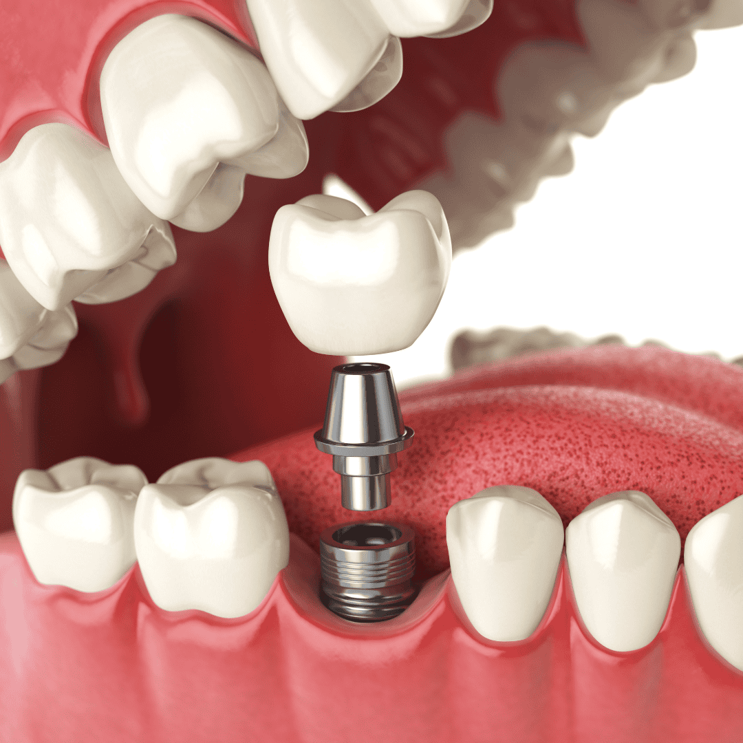 Dental Implants Brisbane