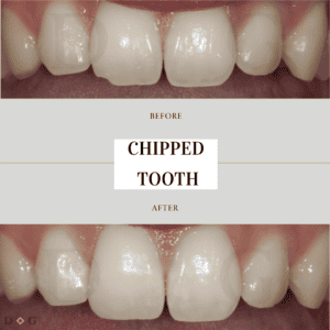 Before and after results of subtle cosmetic dental treatment for professionals