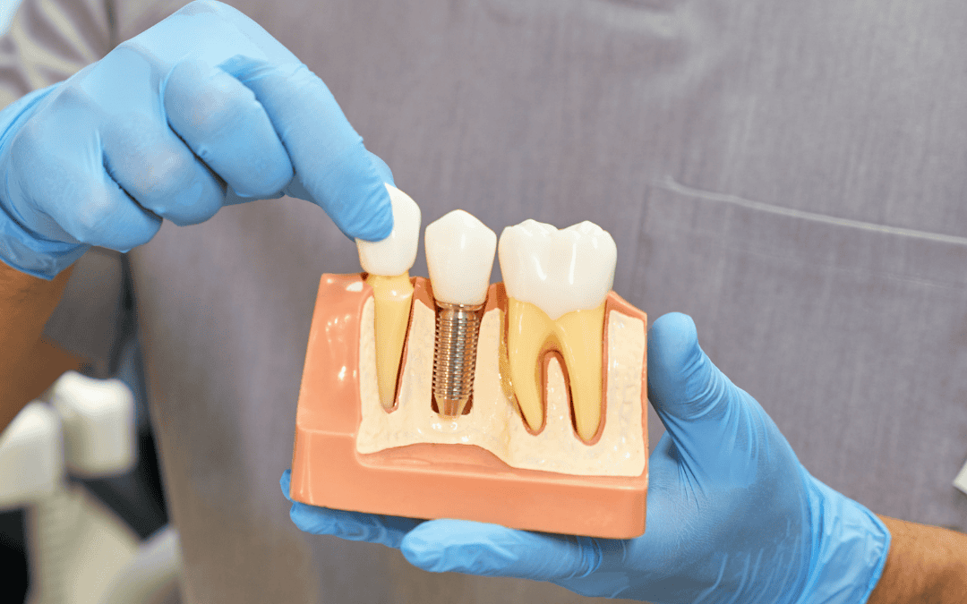Why Dental Implants Are A Premier Tooth Replacement Option