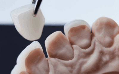 Veneers Brisbane: A Realistic 2026 Guide