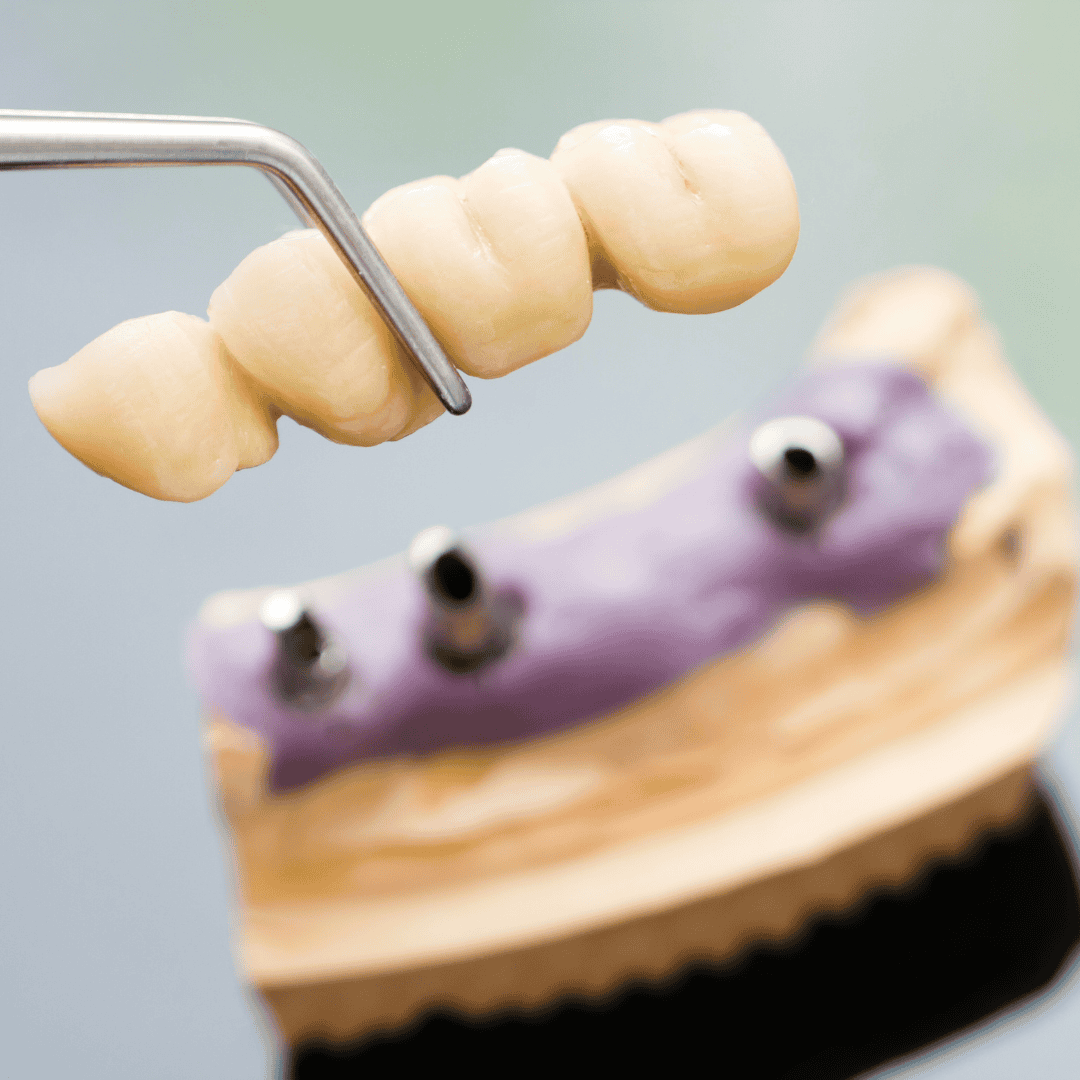 dental implants brisbane